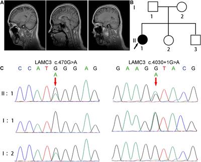 Variants in LAMC3 Causes Occipital Cortical Malformation